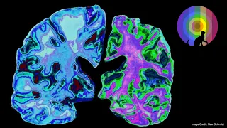 Untangling The Causes Of Alzheimer's Disease | Prof Louise Serpell