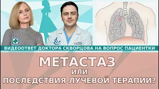 Метастаз (мтс) или последствия лучевой терапии?