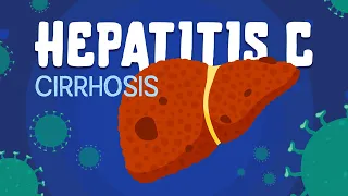 Hepatitis C & Cirrhosis // symptoms, diagnosis & treatment