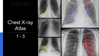 Chest X-ray Atlas: 5 Essential Chest X-rays for Students