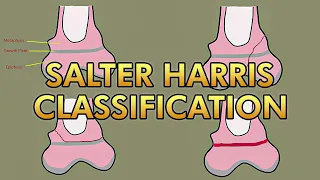 Salter Harris Classification for Pediatric Growth Plate Fractures