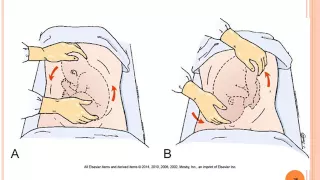 OB Chapter 17 Labor & Birth Complications