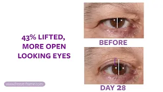 Non-surgical EYELID LIFT, upper eyelid lifting serum.