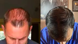 Hair Restoration Laboratories Shampoo (Before and After), Does It Work?