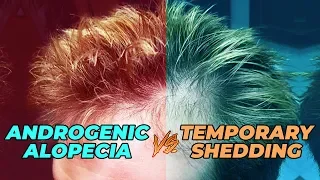 How To Test If Your Hair Loss Is Androgenic Alopecia Or Temporary Shedding