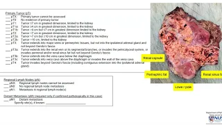 Renal cell carcinoma I: Pathology evaluation gross