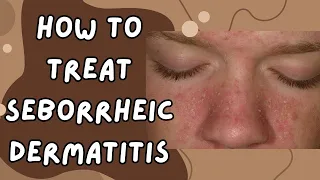 SEBORRHEIC DERMATITIS TREATMENT Get Rid of DANDRUFF NOW!"