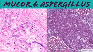 Mucormycosis & Aspergillosis: Angioinvasive Fungal Infection