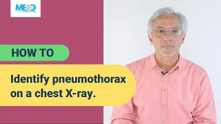 How to identify pneumothorax on a chest X-ray.