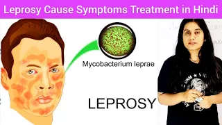 Leprosy Cause Symptoms Treatment Prevention in Hindi | Leprosy In Hindi | Leprosy/Hansen's disease