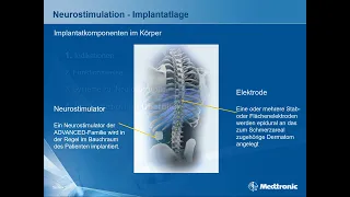 Dr. Georgios Matis - Neuromodulation - Neurostimulation bei chronischen Schmerzen