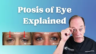 Ptosis of the Eye Explained | Eyelid Surgery for Droopy Eyelids