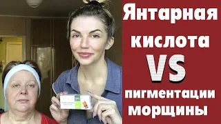 Янтарная кислота от пигментации и морщин 50+.Пилинг из янтарной кислоты для кожи с куперозом и АКНЕ