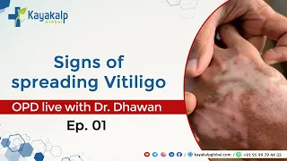 Signs of spreading Vitiligo | OPD with Dr. Dhawan | Ep. 01 @KayaKalp | 📞 9599794433