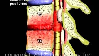 Spinal Infection video - Animation by Cal Shipley, M.D. Trial Image Inc.