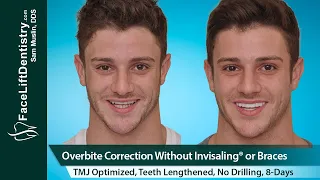 Overbite Correction, No Braces or Invisalign®, No Surgery in 8-Days