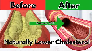 Dietitian reveals secrets to lowering cholesterol by 20% in 3 months!!