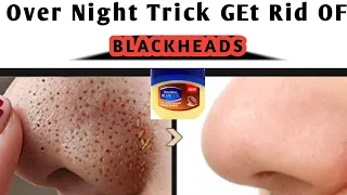 How to Remove Blackheads From Nose | Will Vaseline + Oil Eliminate the Nose blackheads