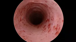 Cystoscopy-Urethral stricture