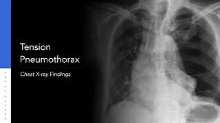 Tension Pneumothorax: Explanation of Chest X-ray Findings