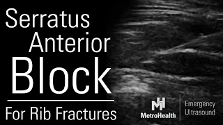 Ultrasound Guided Serratus Anterior Block for Rib Fractures