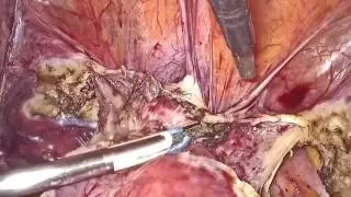 Bladder Dissection in TLH for Previous LSCS