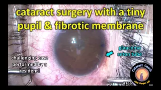 cataract surgery with a tiny pupil and fibrotic membrane