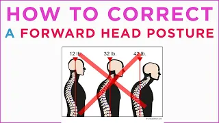 Forward head posture: how to fix it?