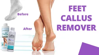 5 Best Feet Callus Remover that Actually Work