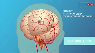 Инсульт: успеть за 4 часа обратиться за медицинской помощью!