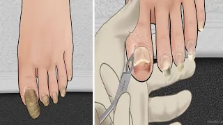 [ASMR] ATHLETES FOOT TOENAILS TREATMENTNIMATION | #animation |#asmr  | #treatment