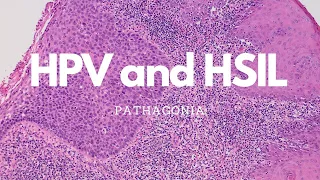 HPV and HSIL: #pathagonia