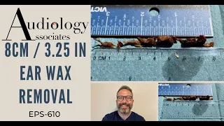 8CM/3.25 IN EAR WAX REMOVAL - EP610