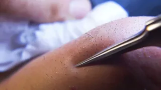 Hair removal asmr pull out with Tweezers  Satisfying pull out beard 10min 202404-2