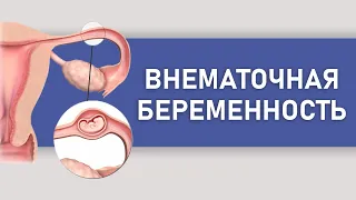 Что делать при внематочной беременности. Признаки и последствия. Зачем делать УЗИ.