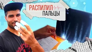 Распилил пальцы на руке. Попал в больницу.