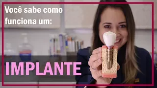 Implante dentário - Você sabe como funciona?