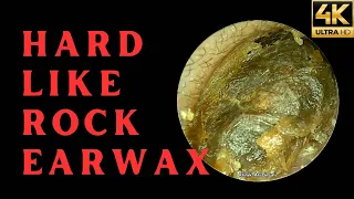 HARD LIKE ROCK EARWAX REMOVAL (4K 60FPS)