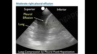 Chest USG Pleural Effusion_Trainee Tutorial_Overview