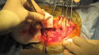 Neurosurgery - Far Lateral Craniotomy