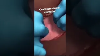 Cesarean section animation l Medical and Nursing l subscribe