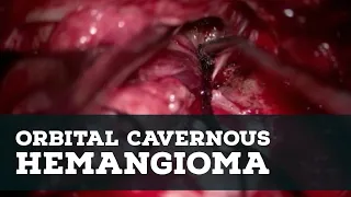 Orbital Cavernous Hemangioma