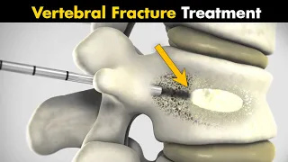 How Vertebral Compression Fracture Is Treated? | Vertebroplasty And Kyphoplasty (Urdu/Hindi)