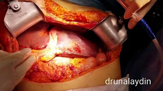 SURGERY OF INOPERABLE TYPE IV  KLATSKIN TUMOR WITH METALIC STENT drunalaydin