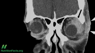 Benefits of Turmeric Curcumin for Inflammatory Orbital Pseudotumor