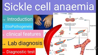 Sickle cell anemia | LAQ | Pathology