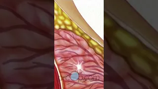 Breast Needle Biopsy Explained 🎗️ #PreOp #PatientEducation #Shorts #cancer  #doublemastectomy  pt 2