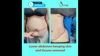 Tummy Tuck Surgery On Table Result | Removed Hanging Skin of Tummy #shorts