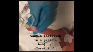 Cannula insertion in a preterm baby by Prof. dr Tarek Kotb