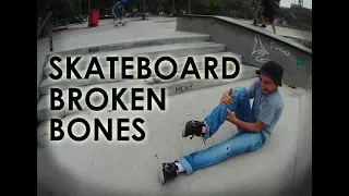 Skateboard Extreme Broken Bones | NOT FUNNY AT ALL
